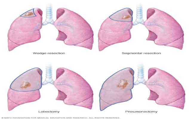 سرطان الرئة: بحث جديد حول الخلايا المناعية وأورام الرئة