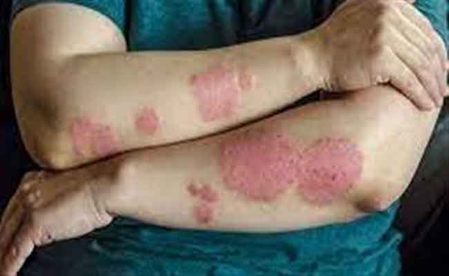 أعراض الذئبة الحمراء الداخلية والخارجية بالتفاصيل الدقيقة