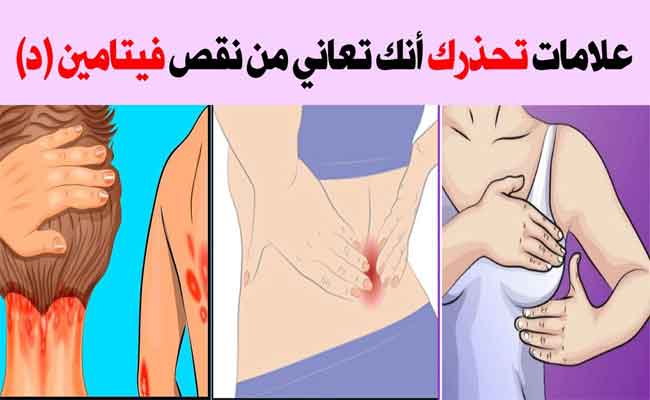 أعراض نقص الكالسيوم وفيتامين د عند النساء…خطيرة