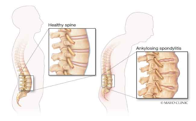 أعراض التهاب الفقار المقسط AS…اكتشفيها باكراً لإدارة الحالة