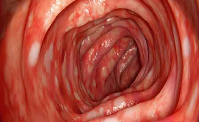 أعراض التهاب المعدة والقولون…والأسباب بالتفصيل الدقيق