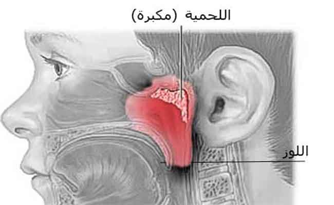 متى تظهر اللحمية عند الأطفال؟
