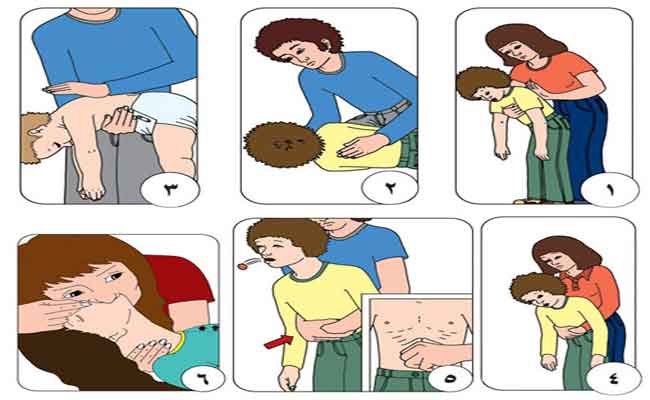 الإسعافات الأولية للاختناق…مهمّة لإنقاذ حياة المصاب