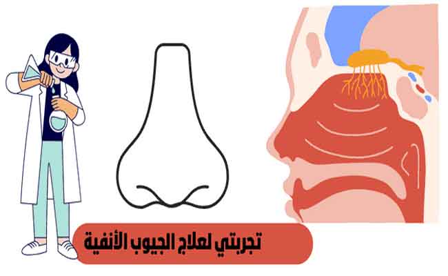 تجربتي مع عملية الجيوب الأنفية…جيدة وغير مؤلمة