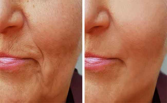 نقص الكولاجين يزيد التجاعيد…