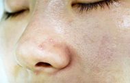 علاج البشرة الجافة طبيعياً وآثار على الجلد يجب أخذها في الاعتبار