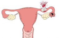 الحمل خارج الرحم...الأسباب والأعراض والعلاج