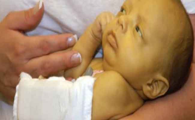 علاج الصفار عند حديثي الولادة بالبيت