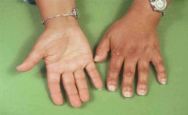 ما هو مرض أديسون وطرق علاجه؟…تفاصيل علمية صادمة