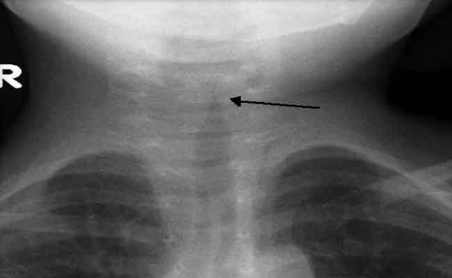 أسباب وأعراض الخانوق أثناء الحمل تعرفي إليها…