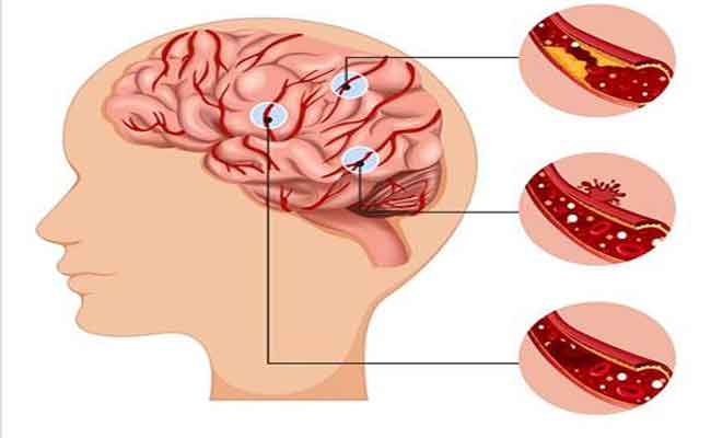 ما هي السكتة الدماغية؟…أنواعها وأعراضها والعلاجات