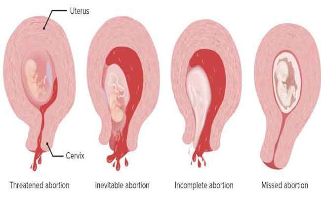 عوامل تسبب الإجهاض التلقائي…وطرق الوقاية منه