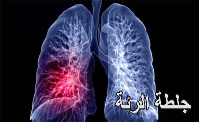 أعراض جلطة الرئة على مستوى عالٍ من الخطورة…