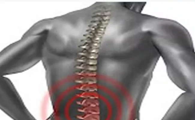 علاج اعوجاج العمود الفقري بالرياضة…اسألي طبيبك عنها