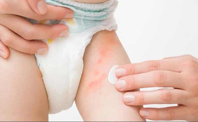 مخاطر التهابات الحفاض عند الرضع وطرق العلاج…