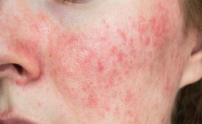 الوردية أثناء الحمل: ما هي وكيف يمكنك علاجها؟