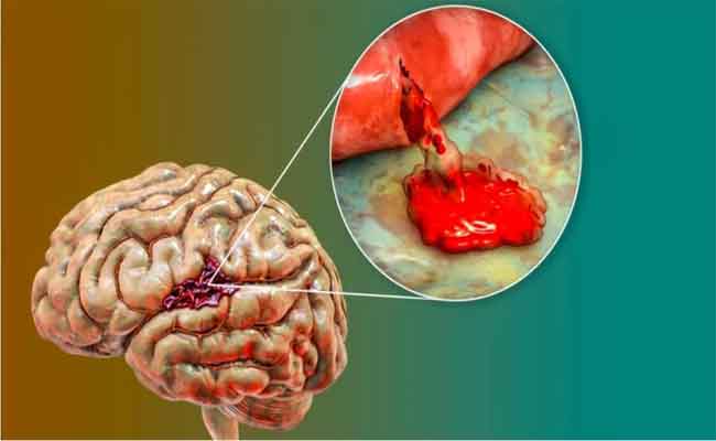 تجربتي مع نزيف الدماغ عند الأطفال…