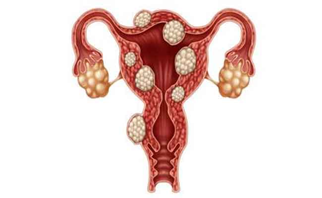 الأورام الليفية الرحمية: علاج جديد لا يعتمد على الجراحة