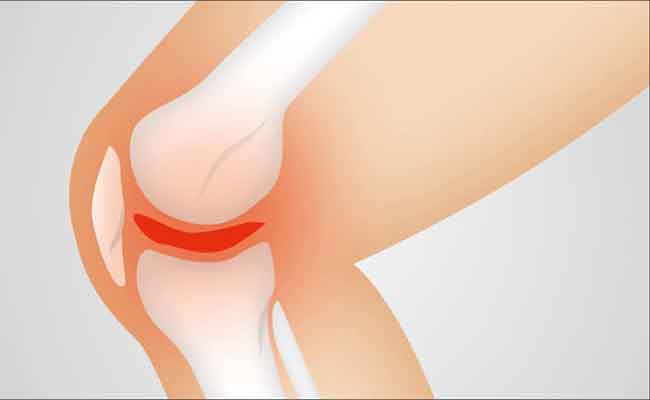 هشاشة العظام: أربعة علاجات طبيعية لتخفيف المرض والألم الناتج عنه