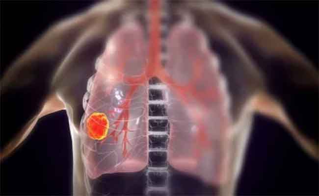 سرطان الرئة: اكتشفي هذا العنصر الغذائي الذي يمنعه…وفق دراسة