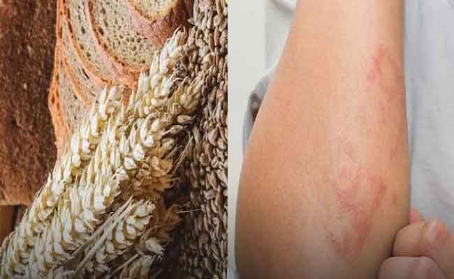 أعراض حساسية الجلوتين…الأسباب وطريقة العلاج وفق اختصاصية