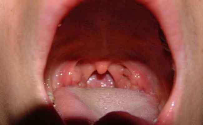 أسباب التهاب اللوزتين عند الأطفال…