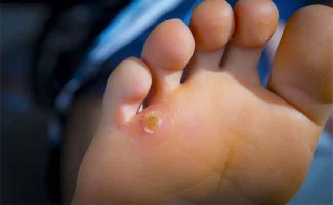 علاج مسمار اللحم في القدم بسهولة…إليك أبرز الطرق