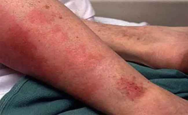 حملة تحسيسية و توعوية حول أخطار الحمى المالطية و التطبيب الذاتي