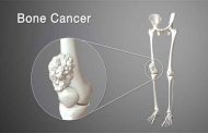 أعراض سرطان العظام عند النساء والمزيد من التفاصيل حول المرض...