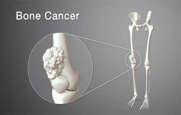 أعراض سرطان العظام عند النساء والمزيد من التفاصيل حول المرض...