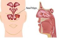 أعراض وأسباب لحمية الأنف...والطرق العلاجية للتخلص منها