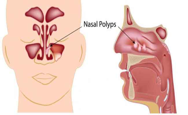أعراض وأسباب لحمية الأنف…والطرق العلاجية للتخلص منها