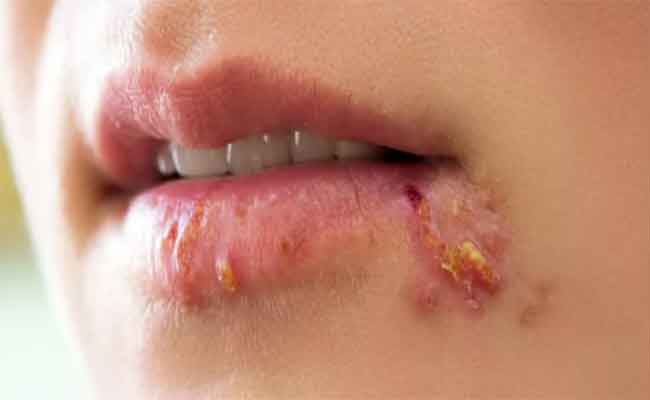 أمراض تنتقل للأطفال عن طريق اللعاب وكيفية علاجها