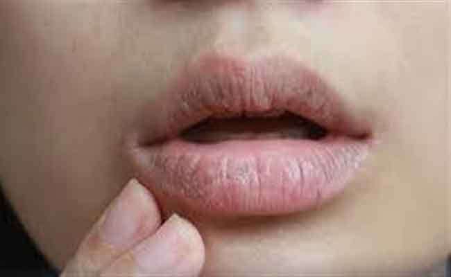 أسباب جفاف الشفاه أثناء الحمل ومتى يجب الذهاب للطبيب؟