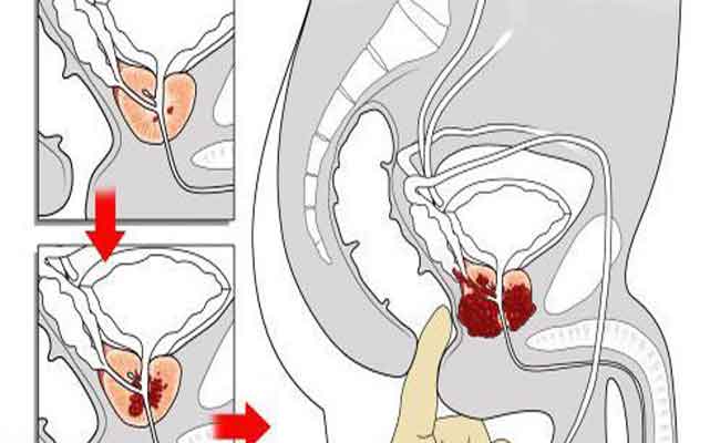أسباب وأعراض سرطان البروستاتا وعوامل الخطر…