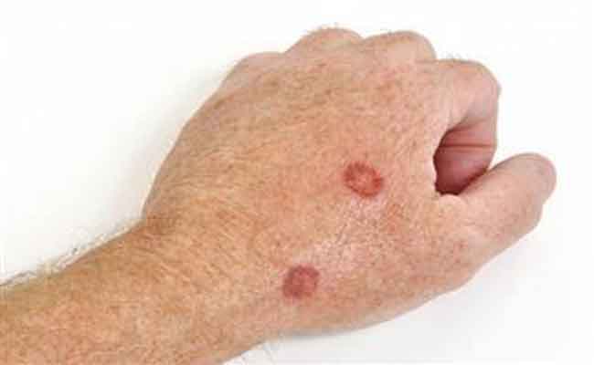 في شهر التوعية بسرطان الجلد…7 نصائح تقي من الإصابة