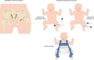 خلع الورك الخلقي لدى حديثي الولادة...أسبابه وطرق علاجه؟