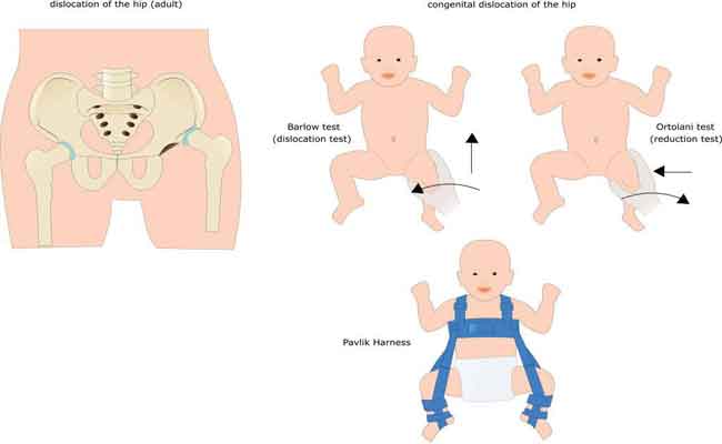 خلع الورك الخلقي لدى حديثي الولادة…أسبابه وطرق علاجه؟