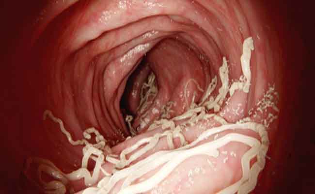 أسباب وأعراض الديدان المعوية لدى الأطفال وكيف يمكن علاجها