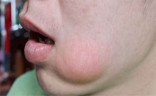 أسباب انتفاخ الوجه عند الأطفال وكيفية علاجه؟