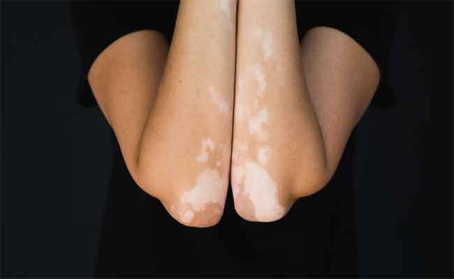 الفرق بين البهاق ونقص التصبغ وهذه تجربتي المزعجة