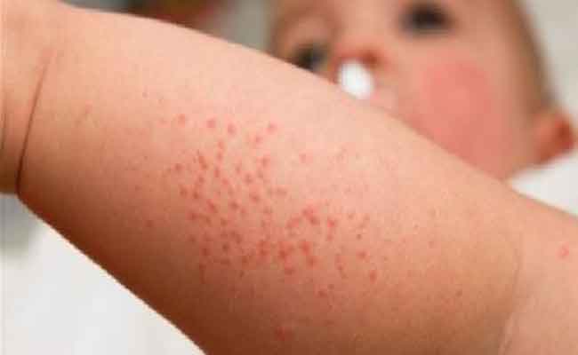 أنواع البقع في جسم الطفل…بعضها لا علاج له!