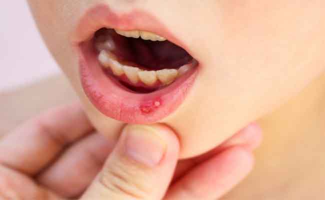 أعراض الهربس عند الأطفال وعلاقته بنزلات البرد؟