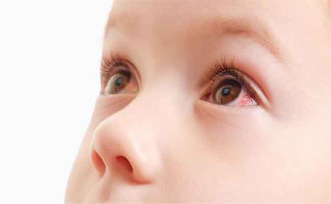 أسباب احمرار العين عند الأطفال الرضع ومتى تكون مؤشراً خطراً؟