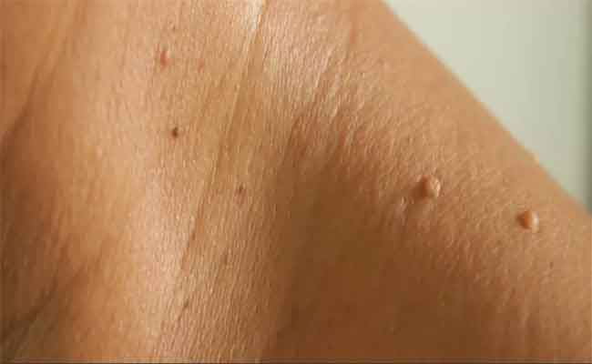 أسباب الزوائد الجلدية أثناء الحمل وأبرز العلاجات الآمنة للتخلص منها