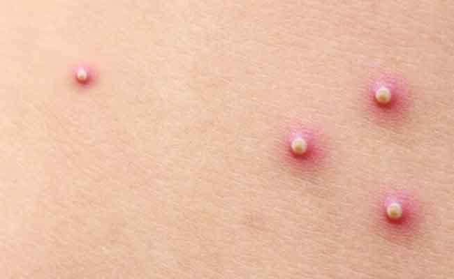 أسباب ظهور الحبوب البكتيرية بالجسم والعلاجات…