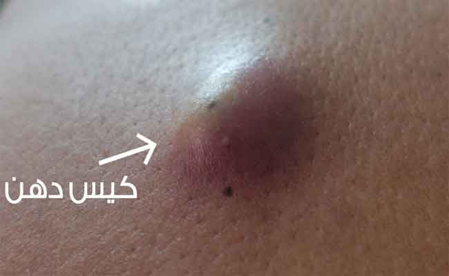 الأكياس الدهنية لماذا تنتشر وكيف نحمي أنفسنا منها؟