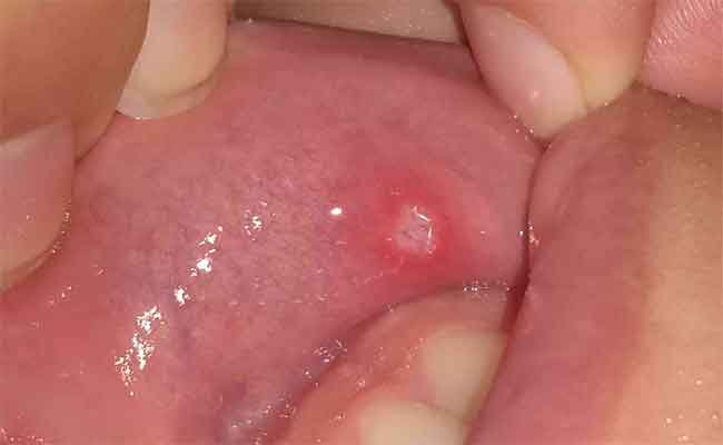تجربتي مع تقرحات الفم وطرق القضاء عليها