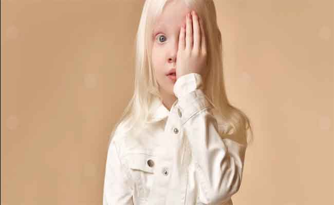 المهق: كل التفاصيل عن هذا المرض الوراثي