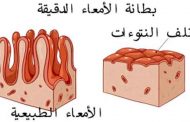 ما هو مرض السيلياك وأعراضه؟...وأفضل علاج